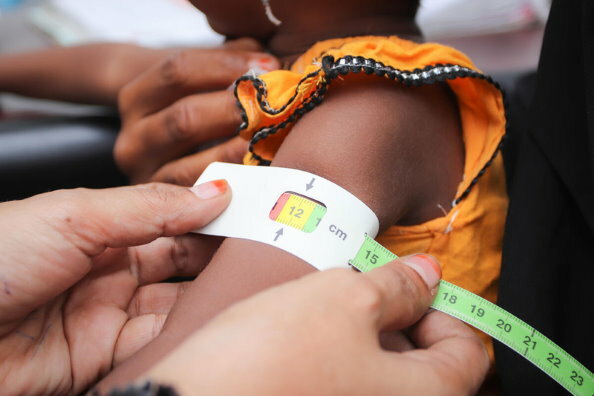 Nations Unies: au Yémen, la malnutrition aiguë menace la moitié des enfants de moins de cinq ans en 2021 