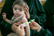 Yémen. Mohammed, âgé de 10 mois, est examiné pour malnutrition par l'agent de santé Zahra à l'hôpital Al Shaheed. 
